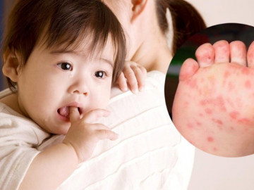 Số ca tay chân miệng tăng gấp đôi, chủ yếu ở miền Nam
