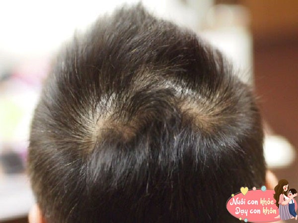 Nhiều người vẫn truyền tai nhau những đứa trẻ có hai xoáy tóc trên đầu thường thông minh hơn người.