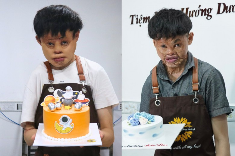 Từ một cậu nhóc lẩn tránh ánh mắt của người đời, Hải “sẹo” giờ trở thành một thanh niên tự lập: “Gương mặt trơn láng hơn, khác hẳn vết sẹo chằng chịt lúc trước giúp mình tự tin hơn rất nhiều”. 