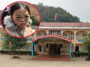 Công an vào cuộc làm rõ vụ bé gái lớp 1 nghi bị cô giáo đánh tím mắt ở Yên Bái