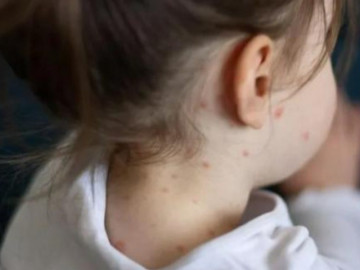 Hà Nội ghi nhận ca mắc sởi đầu tiên đã tiêm 3 mũi vắc xin, bác sĩ hướng dẫn việc cần làm ngay để...