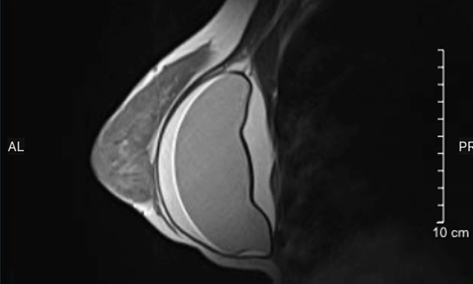 Hình ảnh MRI túi ngực bị vỡ. Ảnh: Bệnh viện cung cấp
