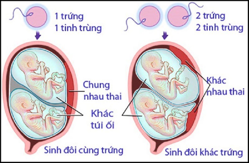 Song thai được hình thành theo các cách khác nhau sẽ sinh ra những em bé khác nhau. Có hai loại thai đôi: thai đôi cùng trứng và thai đôi khác trứng. 
