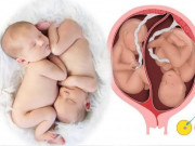 Bà bầu - Không phải trẻ sinh đôi nào cũng giống nhau bởi có 7 kiểu sinh đôi mà cha mẹ chưa biết