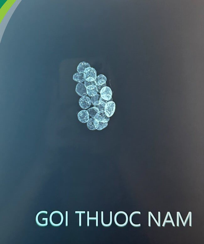 Hình ảnh viên thuốc nam trẻ uống không rõ nguồn gốc có chứa chì trên phim chụp Xquang