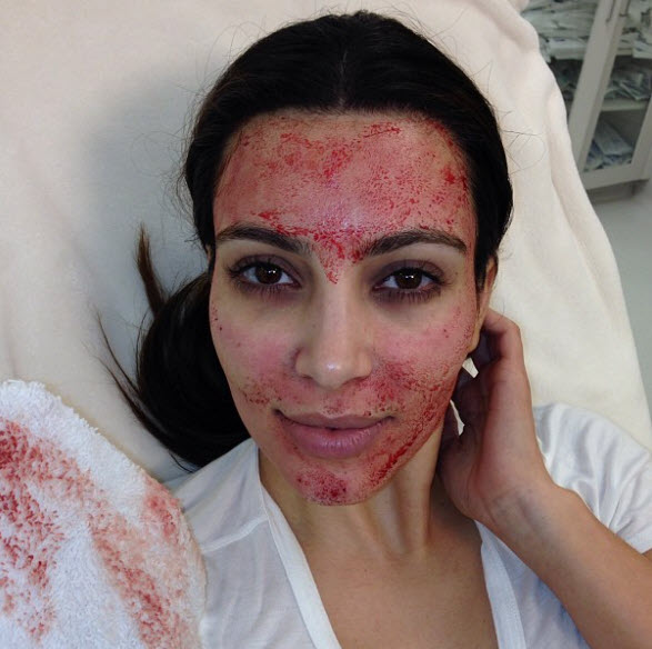 Kim Kardashian từng đăng ảnh vừa trải qua liệu pháp lăn kim lên trang cá nhân. 