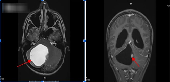 Kết quả chụp cho thấy hình ảnh khối u sao bào lông ở não của Nam. Ảnh: BVCC.