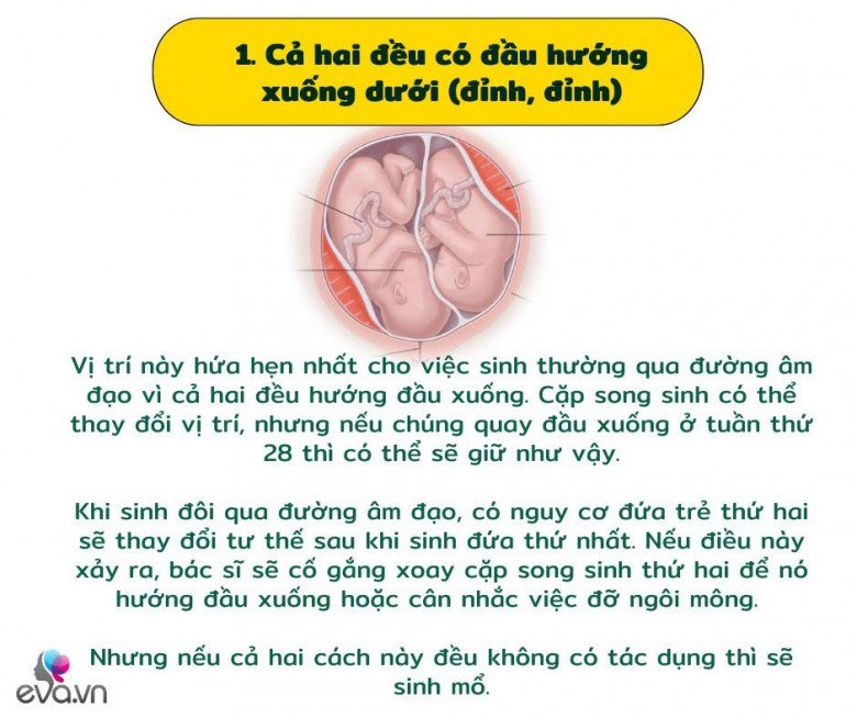 Khám phá các vị trí của cặp song sinh trong bụng mẹ và ảnh hưởng của nó đến quá trình sinh nở - 2
