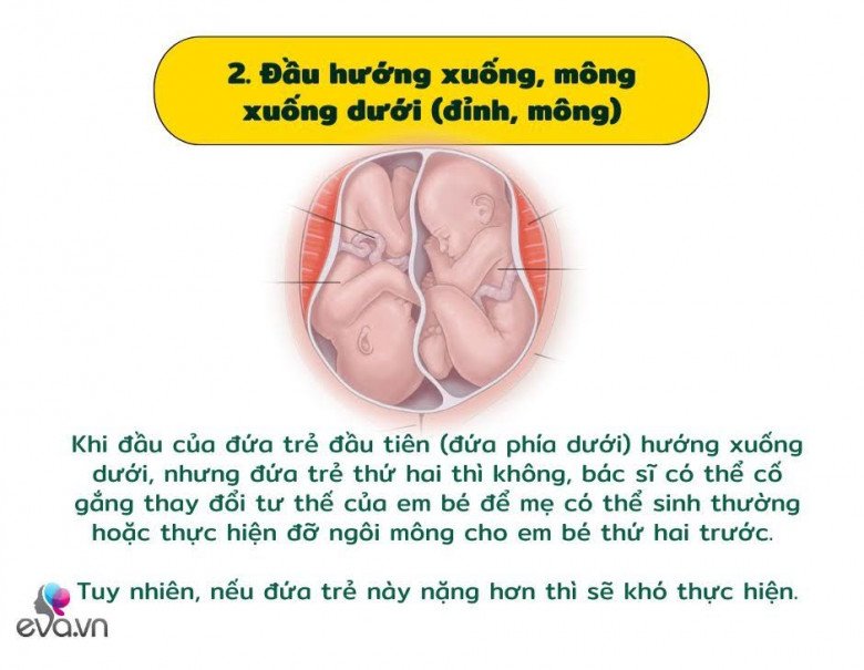 Khám phá các vị trí của cặp song sinh trong bụng mẹ và ảnh hưởng của nó đến quá trình sinh nở - 3