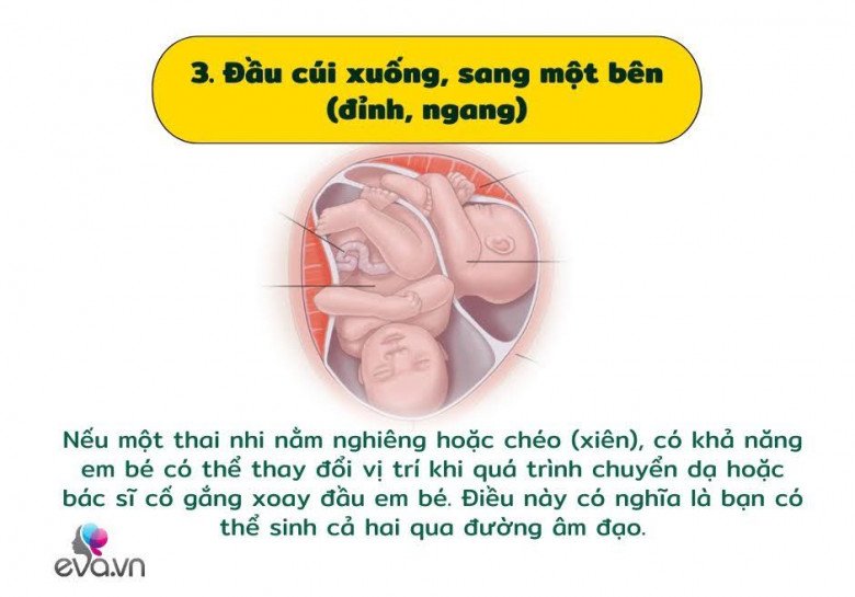 Khám phá các vị trí của cặp song sinh trong bụng mẹ và ảnh hưởng của nó đến quá trình sinh nở - 4