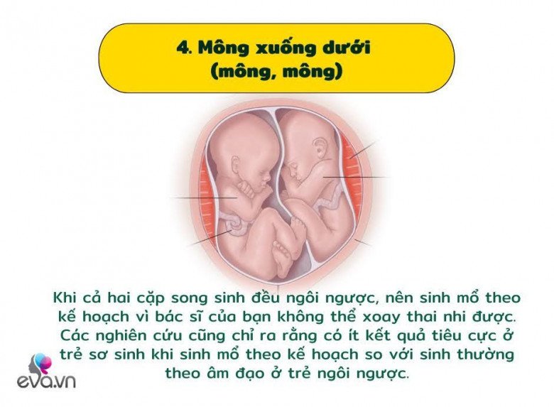 Khám phá các vị trí của cặp song sinh trong bụng mẹ và ảnh hưởng của nó đến quá trình sinh nở - 5