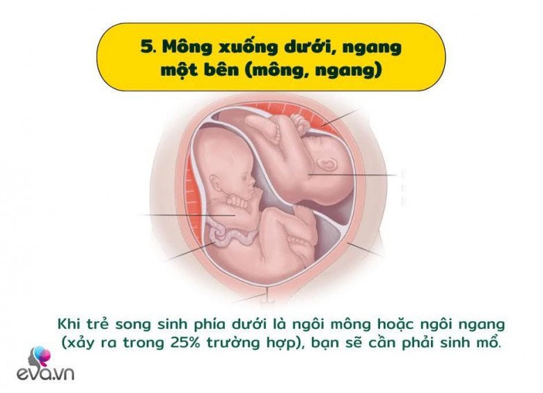 Khám phá các vị trí của cặp song sinh trong bụng mẹ và ảnh hưởng của nó đến quá trình sinh nở - 6