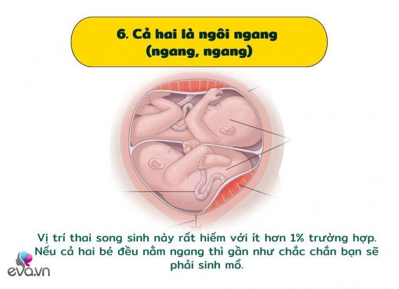 Khám phá các vị trí của cặp song sinh trong bụng mẹ và ảnh hưởng của nó đến quá trình sinh nở - 7
