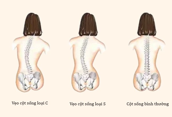 Các vấn đề như vai tròn và lưng gù, vai cao và thấp, chân dài và ngắn... ảnh hưởng đến ngoại hình, còn gây ra một số bệnh.
