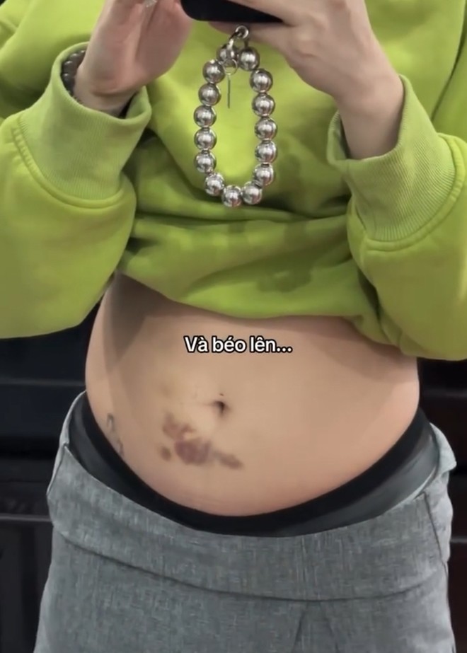 Cô tiêm kích trứng để làm IVF, bụng thâm tím và béo lên do thay đổi nội tiết.