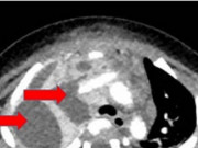Sức khỏe - Bé 7 tháng tuổi nguy kịch vì nhiễm vi khuẩn "vô địch kháng kháng sinh"