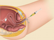 Chuẩn bị mang thai - Sự khác biệt giữa thụ tinh trong tử cung và thụ tinh trong ống nghiệm