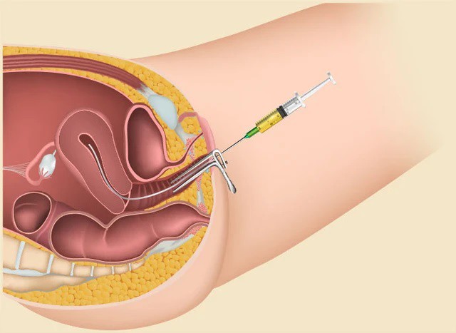 a hrefhttps://eva.vn/bom-tinh-trung-vao-tu-cung-p1366c85.htmlThụ tinh nhân tạo trong tử cung (IUI)./a