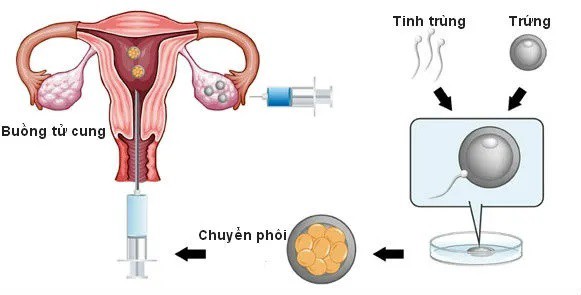 a hrefhttps://eva.vn/thu-tinh-nhan-tao-p1364c131.htmlThụ tinh trong ống nghiệm (IVF)./a