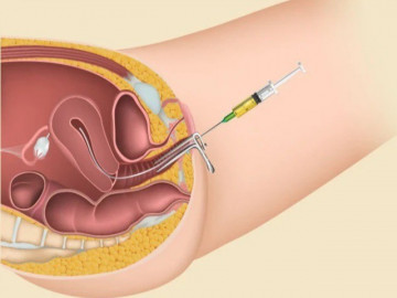 Sự khác biệt giữa thụ tinh trong tử cung và thụ tinh trong ống nghiệm