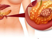 Sức khỏe - Không hút thuốc, uống rượu, người phụ nữ bị ung thư tuyến tụy, bác sĩ chỉ ra "thủ phạm" không ngờ tới