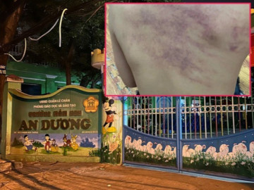 Công an vào cuộc vụ cháu bé nghi bị bạo hành tại trường mầm non