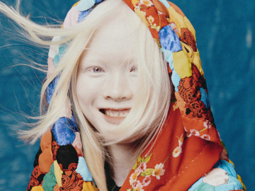 Cô gái bạch tạng trầm cảm vì bị kỳ thị