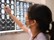 Sức khỏe - Giám đốc Bệnh viện K chỉ ra những dấu hiệu cần nghĩ ngay đến bệnh u não