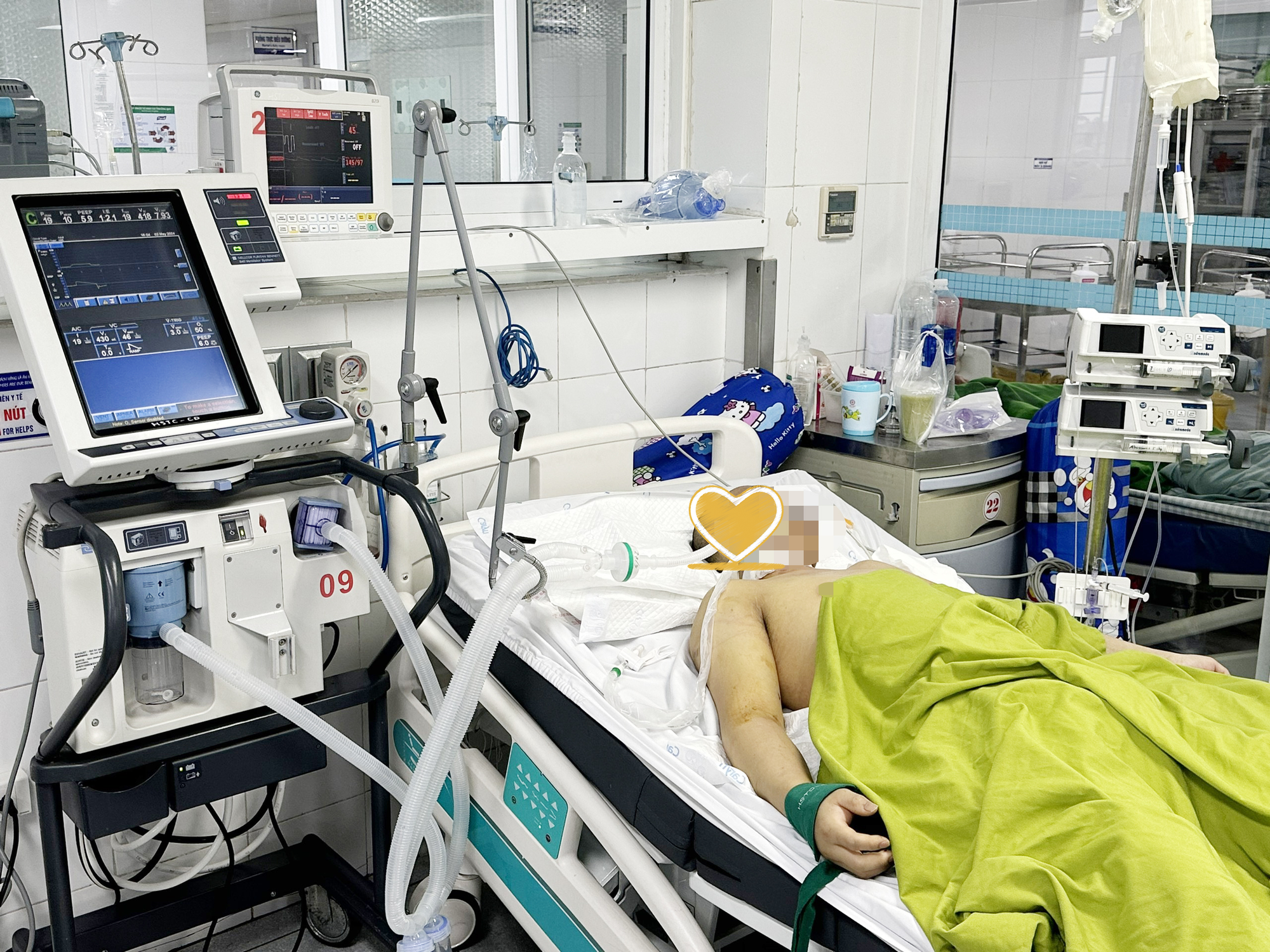 Người bệnh sốc nhiệt trong tình trạng nặng, hôn mê, phải thở máy ngay khi nhập viện. Ảnh: BVCC