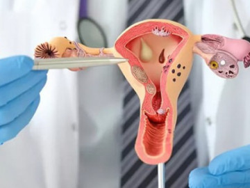 Buồng trứng đa nang ảnh hưởng tới khả năng sinh sản như thế nào?