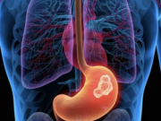 Sức khỏe - Tử vong sau ba tuần uống nước kiềm chữa ung thư