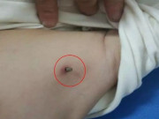 Yêu con - Con bị côn trùng cắn, một hành động của người mẹ suýt chút nữa khiến đứa trẻ ra đi mãi mãi