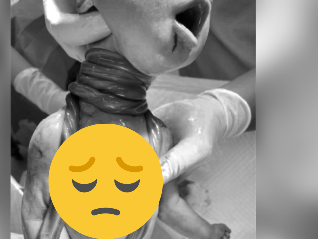 Dây rốn quấn cổ 4 vòng. (Ảnh minh họa)