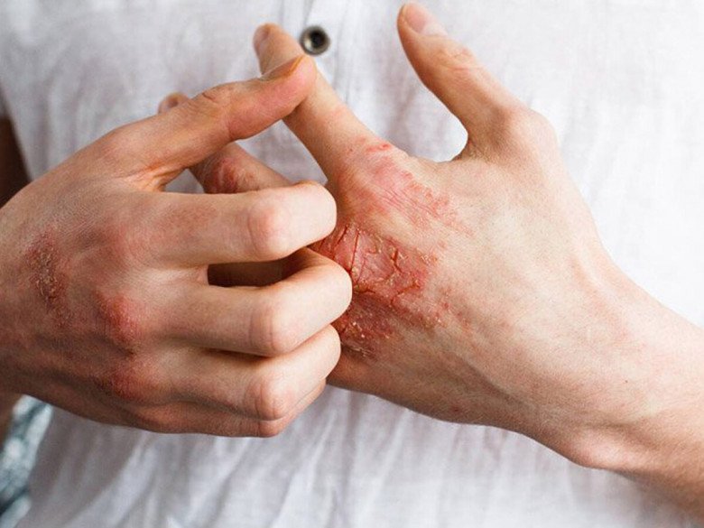 Giang mai và HIV có mối quen hệ với nhau. Ảnh minh họa.