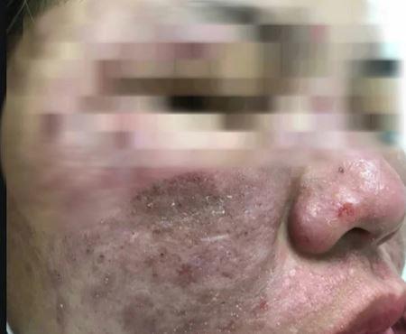 Một trường hợp bị biến chứng sau khi làm đẹp tại spa đã đến Bệnh viện Da liễu Trung ương điều trị