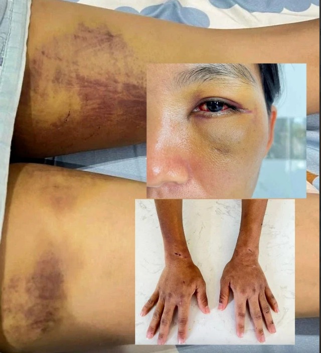 Chị D được xác định bị các thương tích như: bầm quanh mắt, gò má; xuất huyết kết mạc mắt 2 bên; vết bầm 2 cẳng bàn tay, mặt trong 2 đùi; sưng bầm sống mũi và nhiều thương tích ở vùng kín, gãy cung trước xương sườn số 7, số 8, gãy xương chính mũi... Ảnh: TNO