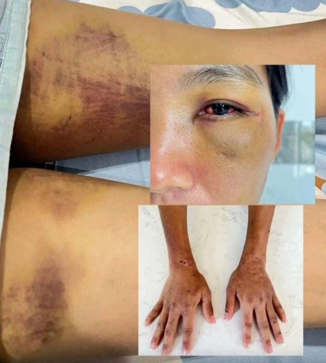 Chị D. bị gia đình chồng cũ bạo hành trong thời gian dài.