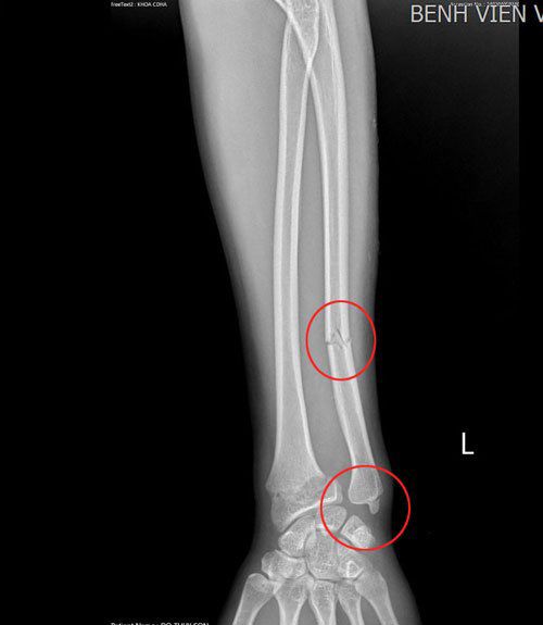 Hình ảnh gãy xương của cô gái do áo chống nắng cuốn vào bánh xe. Ảnh: BVCC.