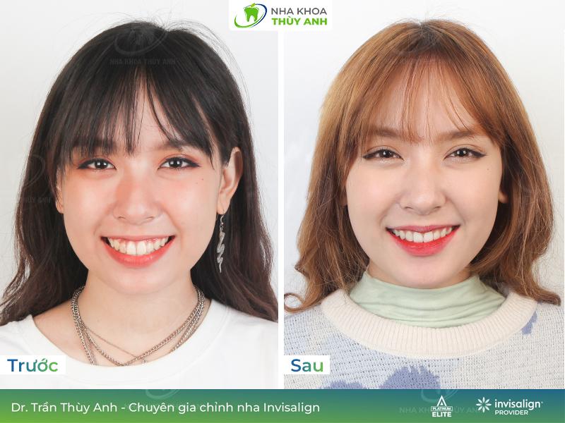 Niềng răng trong suốt invisalign tại Nha khoa Thùy Anh - 5
