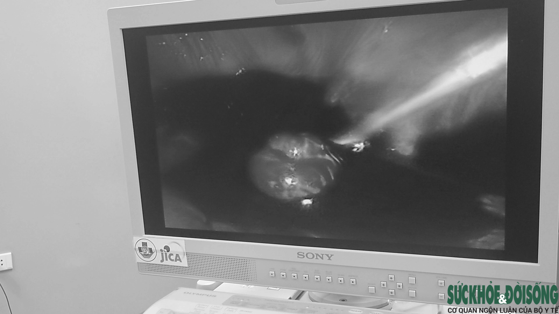 Hình ảnh siêu âm mang thai ngoài tử cung.