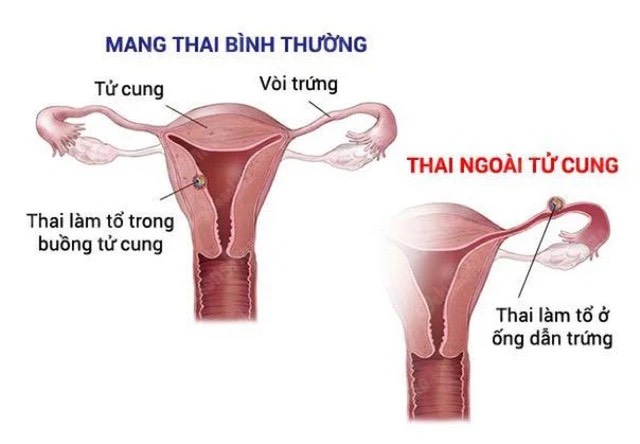 Hình ảnh biến chứng thai kỳ do thai ngoài tử cung. (Ảnh minh hoạ).