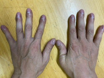 Người đàn ông 44 tuổi đi khám xương khớp bất ngờ phát hiện mắc ung thư phổi từ dấu hiệu ở 10 ngón tay