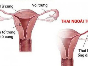 Câu hỏi thường gặp về mang thai ngoài tử cung