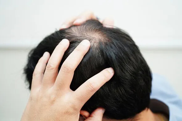 Tóc rụng từng đám lốm đốm, nam thanh niên 34 tuổi đi khám bất ngờ phát hiện mắc giang mai.