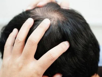 Rụng tóc kiểu 'rừng thưa', nam thanh niên bất ngờ phát hiện bệnh lây truyền qua đường tình dục