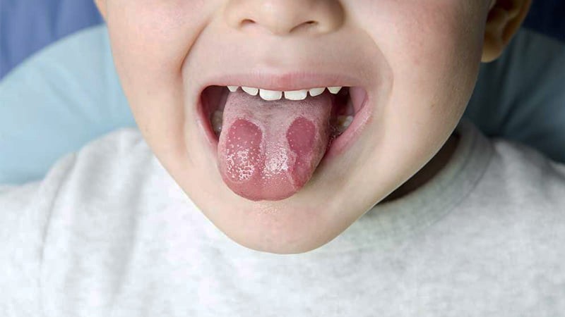 Một số dấu hiệu ở lưỡi biểu hiện tình trạng sức khỏe của bạn. Nếu bề mặt lưỡi trở nên trơn nhẵn giống như bị sưng lên thì bạn có thể bị viêm lưỡi (glossitis). Đây thường là dấu hiệu cho thấy bạn bị thiếu sắt hoặc vitamin nhóm B như B9, B3, B2 và B12.
