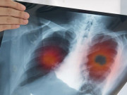 Sức khỏe - Người phụ nữ 30 tuổi sốc vì mắc ung thư phổi giai đoạn cuối: Có 1 dấu hiệu suốt 6 tháng nhưng bỏ qua