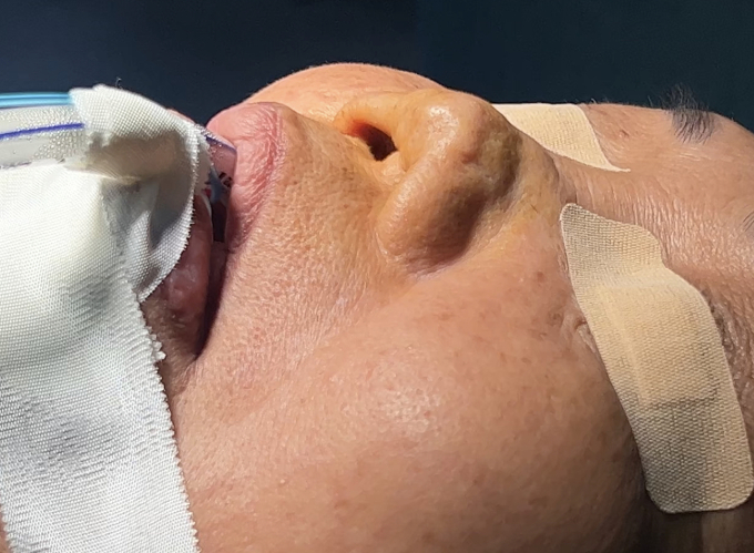 Mũi bệnh nhân co rút, biến dạng sau 7 lần mổ. Ảnh: Bệnh viện cung cấp