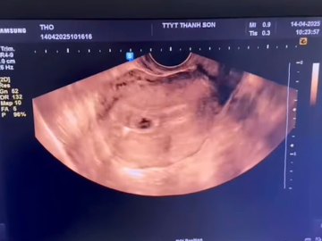 Đặt vòng tránh thai vẫn có bầu