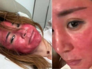 Mặt sưng đỏ, biến dạng sau 22 năm không tẩy trang